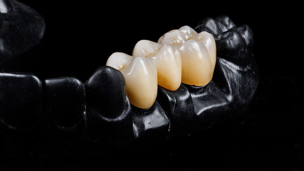 M & D Dental Arts LLC_Service_crown-and-bridge